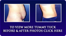tummytuck