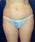 Liposculpture/Liposuction Patient 73931 Photo 2