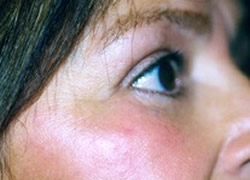 Eyelid Surgery Patient 66205 Photo 2