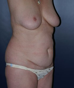 Abdominal Liposuction Patient 14808 Photo 3