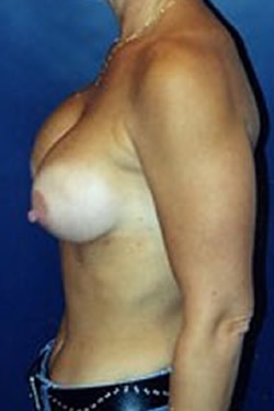 Breast Reconstruction Patient 12096 Photo 4