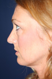 Facelift Patient 54175 Photo 1