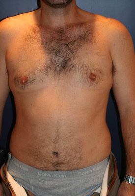 After gynecomastia in New Jersey