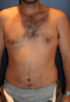 Gynecomastia Patient 60564 Photo 2