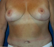 Breast Reduction Patient 23896 Photo 2