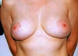 Breast Reduction Patient 14293 Photo 4