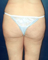 Liposculpture/Liposuction Patient 32081 Photo 4