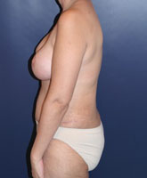 Liposculpture/Liposuction Patient 22793 Photo 4