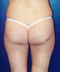 Tummy Tuck Patient 21721 Photo 3