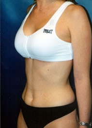 Breast Augmentation Patient 24166 Photo 4