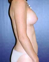 Breast Augmentation Patient 86978 Photo 6