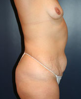 Tummy Tuck Patient 84958 Photo 3