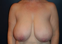 Breast Reduction Patient 38580 Photo 3