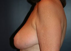 Breast Lift Patient 16247 Photo 2