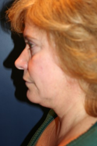 Facelift Patient 86307 Photo 1