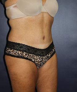 Tummy Tuck Patient 16803 Photo 2