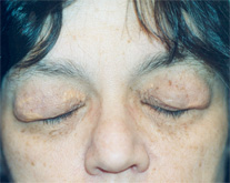 Eyelid Surgery Patient 17292 Photo 3
