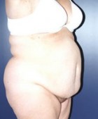 Liposculpture/Liposuction Patient 88624 Photo 1