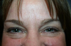 Eyelid Surgery Patient 23084 Photo 5