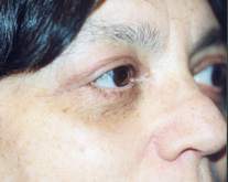 Eyelid Surgery Patient 17292 Photo 6