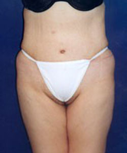 Tummy Tuck Patient 49474 Photo 2