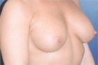 Breast Augmentation Patient 32755 Photo 2