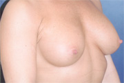 Breast Augmentation Patient 32755 Photo 2