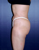 Liposculpture/Liposuction Patient 49367 Photo 2