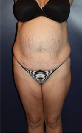 Tummy Tuck Patient 95363 Photo 3