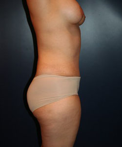 Tummy Tuck Patient 35106 Photo 2