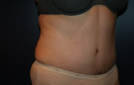 Tummy Tuck Patient 10126 Photo 4