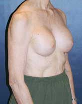 Breast Augmentation Patient 22537 Photo 4