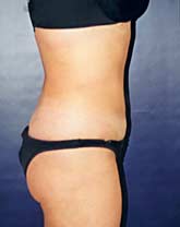 Liposculpture/Liposuction Patient 79741 Photo 2