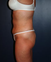 Liposculpture/Liposuction Patient 44612 Photo 4