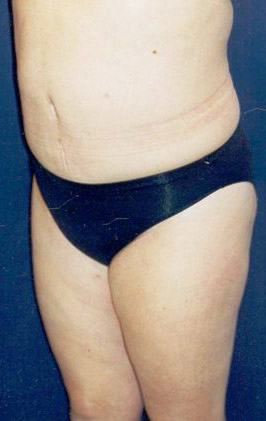 Tummy Tuck Patient 33040 Photo 4