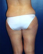 Liposculpture/Liposuction Patient 77135 Photo 5