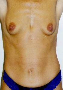 Breast Augmentation Patient 83440 Photo 3