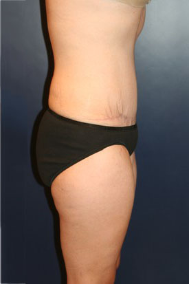 Tummy Tuck Patient 97420 Photo 4