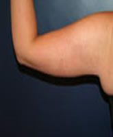 Arm Liposuction and Arm Brachioplasty Patient 15349 Photo 4