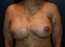 Breast Reconstruction Patient 76022 Photo 2