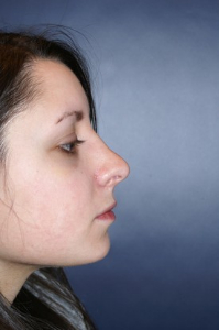 Rhinoplasty Patient 60210 Photo 2