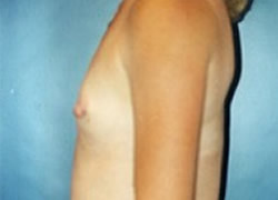 Breast Augmentation Patient 54752 Photo 3