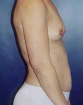 Breast Augmentation Patient 62551 Photo 3