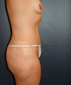 Tummy Tuck Patient 63684 Photo 4