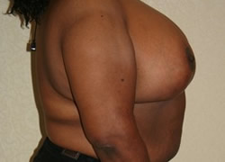 Breast Reduction Patient 54521 Photo 4