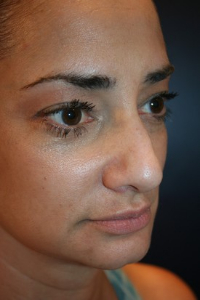 Rhinoplasty Patient 77758 Photo 3