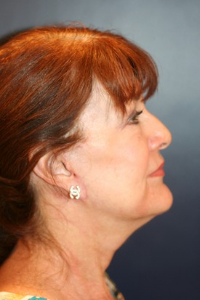 Facelift Patient 12504 Photo 2