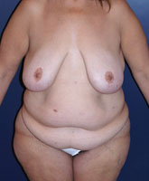Massive Weight Loss Patient 11895 Photo 1
