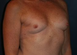 Breast Reconstruction Patient 63352 Photo 1