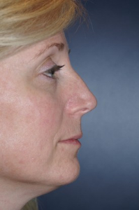 Rhinoplasty Patient 24779 Photo 3